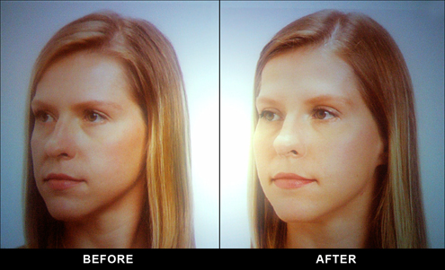 2011_BeforeAfterJuvederm